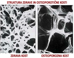 kostna gostota