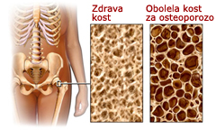 osteoporoza 1